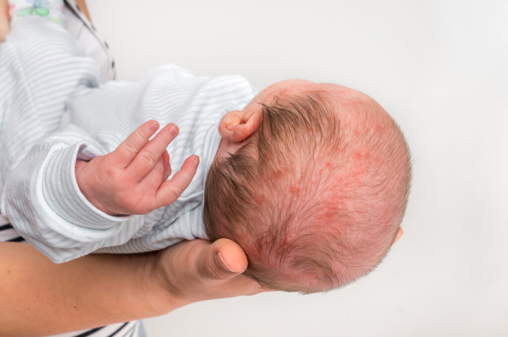 Little newborn baby with skin rash.
