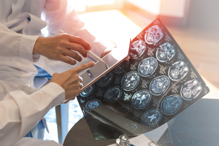 Failure to Diagnose Stroke